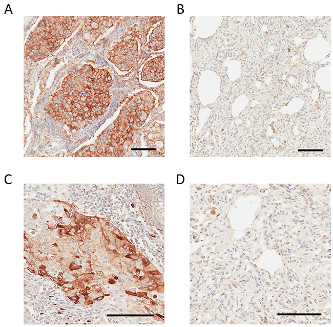 IHC analysis of CD147 and CDH17 in human lung adenocarcinoma and non-cancerous adjacent tissue.
