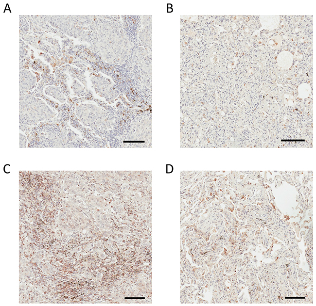 IHC analysis of DC-HIL and ENPP5 in human lung adenocarcinoma and non-cancerous adjacent tissue.