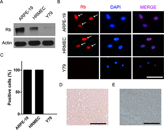 Retinoblastoma is characterized by the loss of functional alleles of RB1 gene.