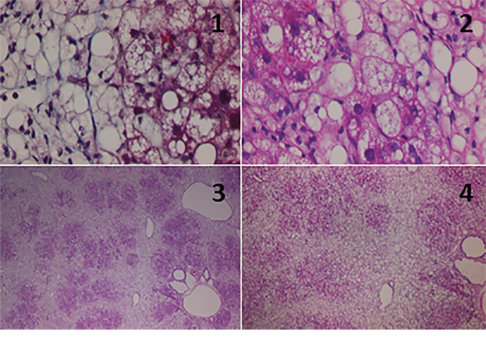 Histological findings for the livers from 19-week-old SHRSP5 rats from the high fat, high cholesterol-containing diet (HFCD) group.