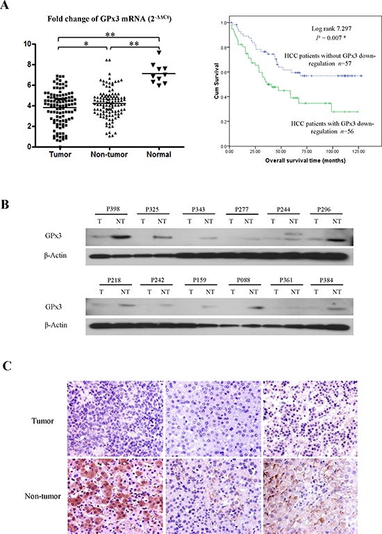 Down-regulation of GPx3 in HCC patients.