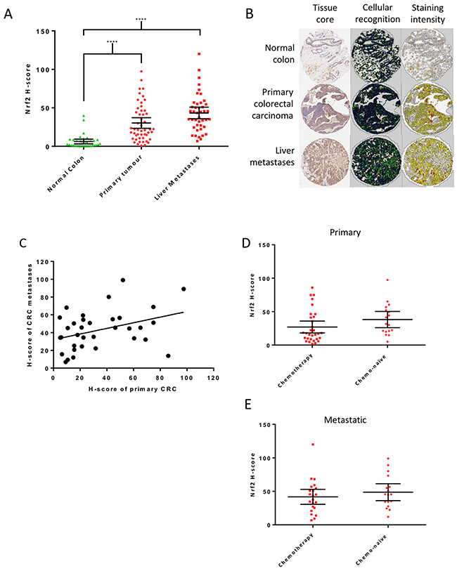 Nrf2 expression in patient samples.