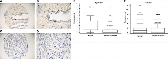 HIST1H1A expression is down-regulated in prostate adenocarcinoma.
