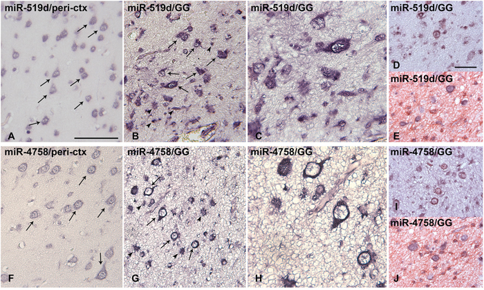 In situ hybridization of miR-519d and miR-4758 expression in peritumoural cortex and ganglioglioma.