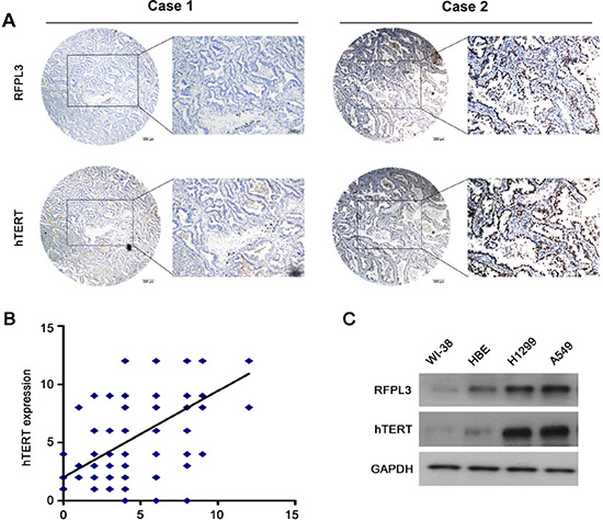RFPL3 expression is positively correlated with hTERT expression in lung adenocarcinoma specimens and lung cancer cell lines.