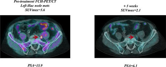 Early FCH-PET/CT complete response on abiraterone treatment.