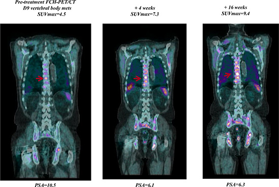 Early FCH-PET-CT progression on abiraterone treatment.