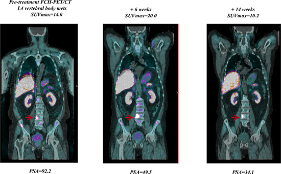 Example of a patient with a rapidly declining PSA level but a week 6 FCH-PET/CT being read as progression in bone lesions.