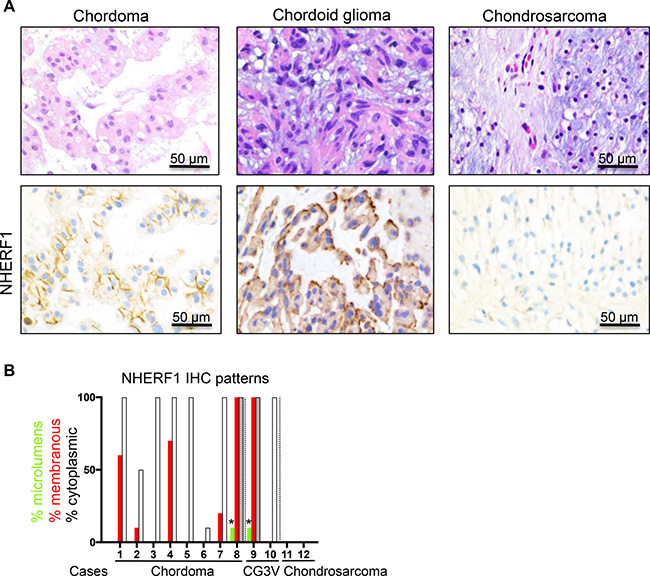 NHERF1 labels the membrane in a subset of chordoma and chordoid glioma and is negative in chondrosarcoma.