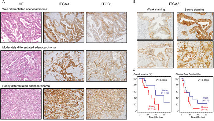 Expression levels of ITGA3/ITGB1 as determined by immunohistochemical staining in PDAC specimens.