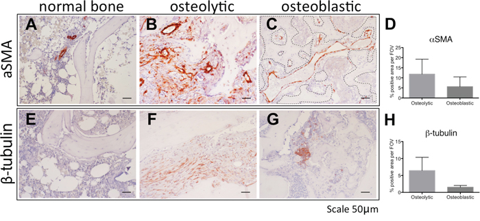 The stroma of human osteolytic bone metastases consist of arteries.