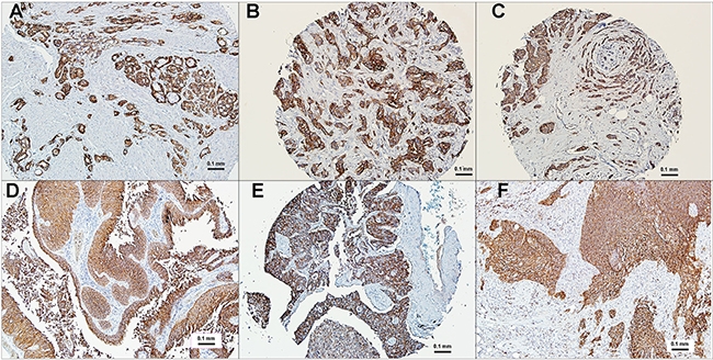 Immunohistochemical localization of TROP-2 in human cancers.