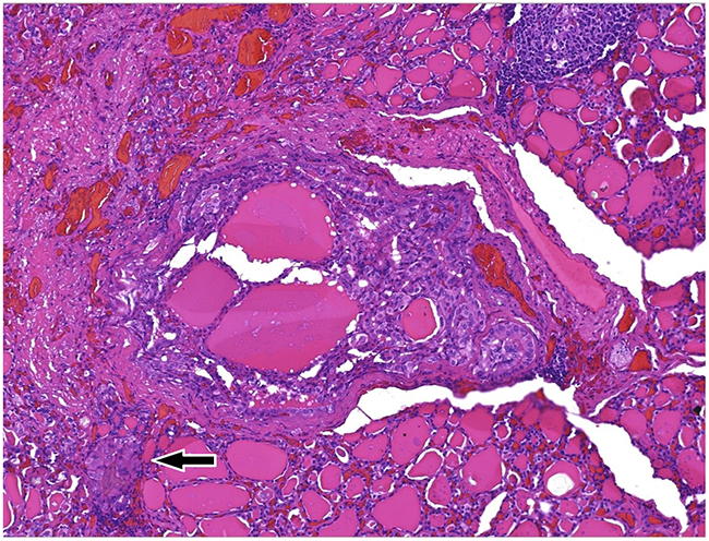 (100x) Whole section of the PTMC, classic variant, &#x00D8; 0.3 cm, devoid of a capsule structure, being made offollicoles and well formed papillae with fibrovascular core, irregular contour, surrounded by newly formed microvessels.