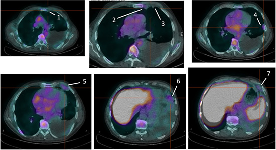 Pre-therapy images of 99mTc-HYNIC-IL2 uptake in metastatic lesions of patient #2.