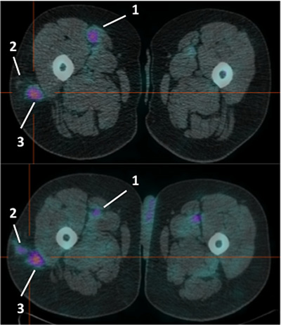 Pre-therapy (upper image) and post-therapy (lower image) images of 99mTc-HYNIC-IL2 uptake in metastatic lesions of patient #4.