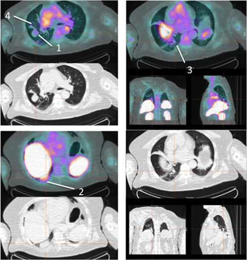 Pre-therapy images of 99mTc-HYNIC-IL2 uptake in metastatic lesions of patient #5.
