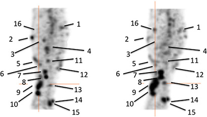 Pre-therapy (left) and post-therapy (right) images of 99mTc-HYNIC-IL2 uptake in metastatic lesions of patient #1.