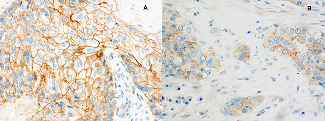 Immunohistochemical staining for &#x03B2;-catenin expression.