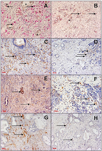 Immunohistological detection of angiopoietins and infiltrating monocytes/macrophages (left column: high density; right column: low density) in TCA of PDAC specimens.