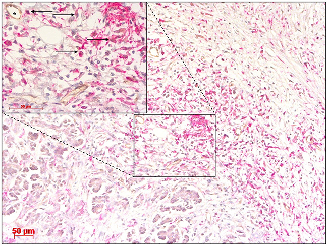 Cholangiocarcinoma stained with antibodies for CD14 and TIE2 showing a high abundance of TIE2-expressing monocytes (TEMs) (arrow) in close proximity to blood vessels (asterisk).