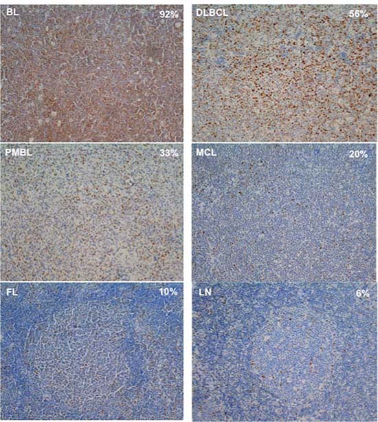 Examples of MYC stain in BL, DLBCL, PMBL, MCL, FL and LN cases.