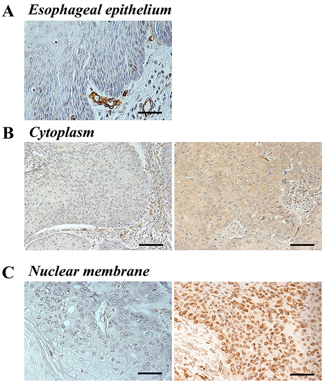 AQP1 protein expression in human ESCC.