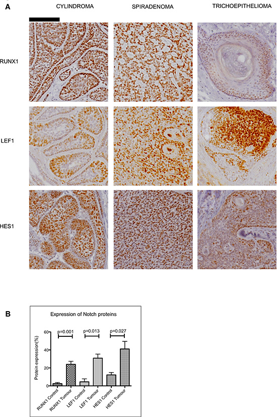 Expression of Notch target genes in CYLD defective tumours.