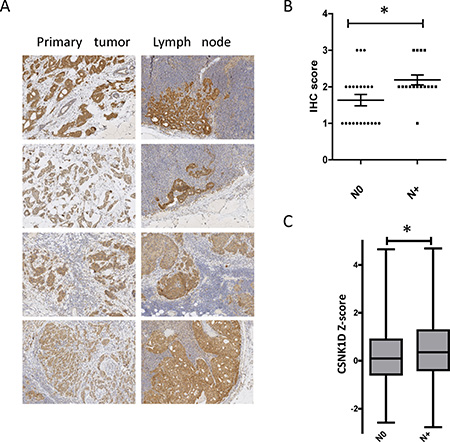 Expression of CSNK1D in primary tumors and metastatic lymph nodes.