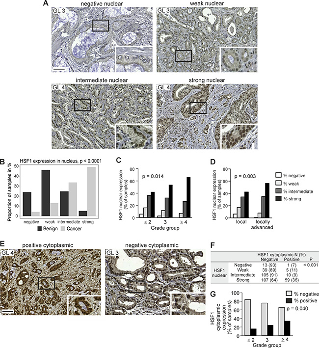 Increased HSF1 protein expression corresponds to the progression of prostate cancer.