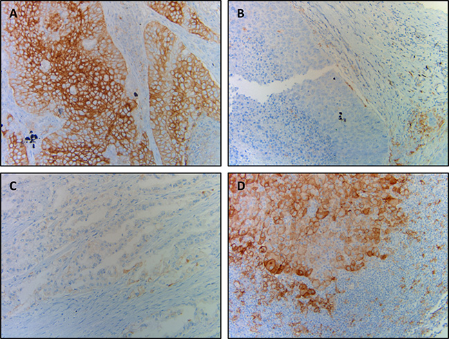 Representative photographs of discrepant PD-L1 expression between primary and metastatic tumors.