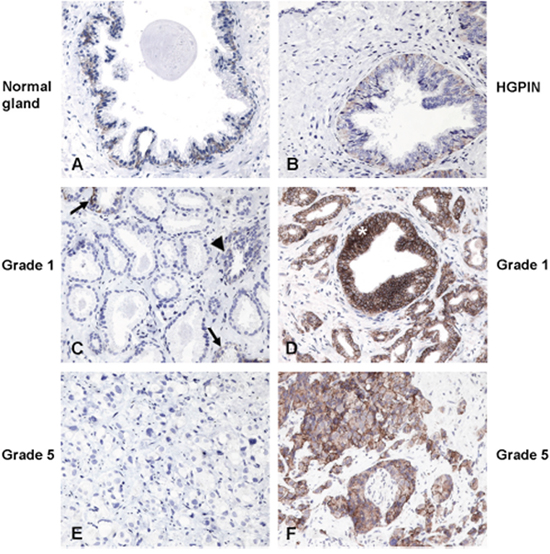 Expression of CD44v8-10 in normal prostate glands and prostate cancers.