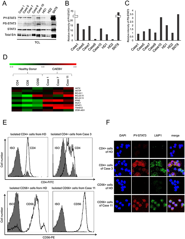 STAT3 is constitutively activated in patient-derived EBV-infected T or NK cells.
