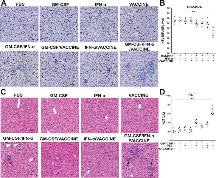 The GM-CSF/IFN-&#x03B1;/VACCINE promoted the clearance of HBcAg-positive hepatocytes.