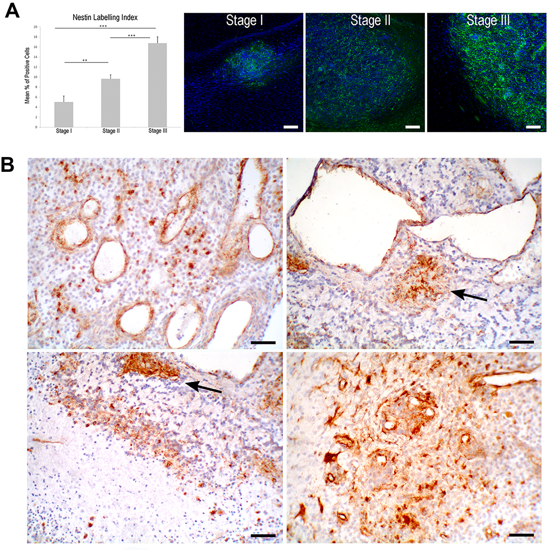 Nestin expression in ENU-glioma development.