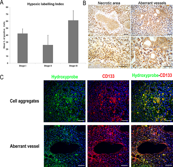 Detection of tissue hypoxia in ENU-glioma by Pimonidazole hydrochloride (Hydroxyprobe&#x2122;-1 solution; Chemicon).