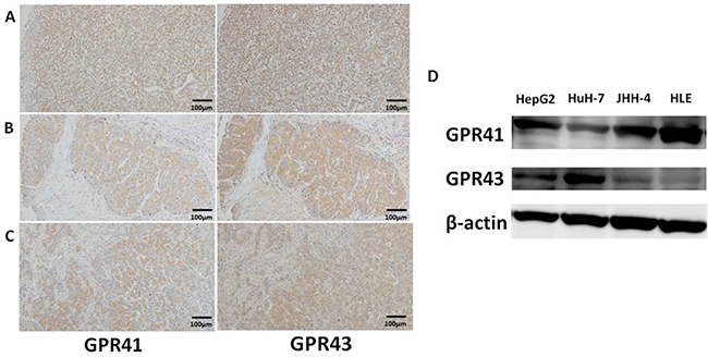 Protein expression of GPR41 and GPR43 in human HCC.