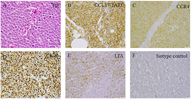 Immunoperoxidase staining of MCPyV-associated MCC primary tumors.