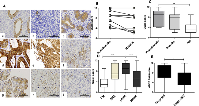 The immunoexpression of AGR2 in in normal and premalignant and malignant human endometrium.