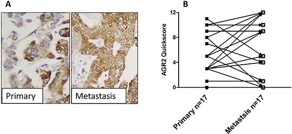 The expression of AGR2 in metastatic lesions.