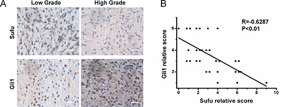 Sufu was negatively correlated with Gli1 expression in human glioma tissues.