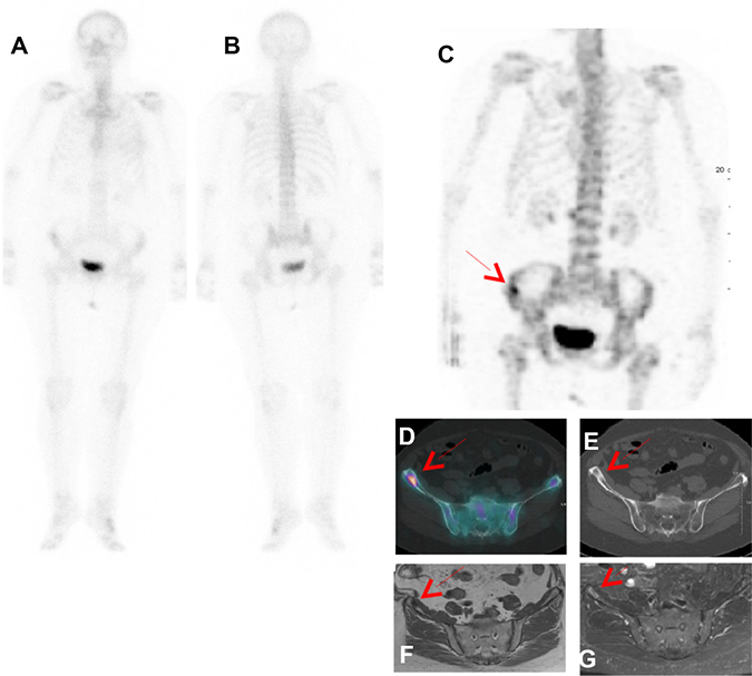 Patient with PBS Sc 3 and trunk SPECT/CT Sc 1 proved as true positive by follow-up.