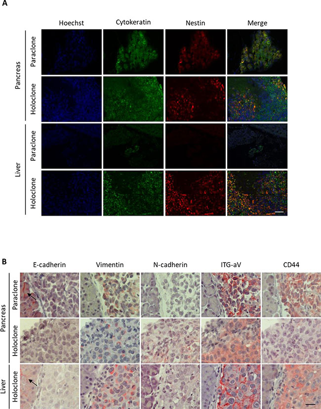 Panc1 holoclone tumors exhibit a pronounced mesenchymal phenotype along with elevated Nestin expression.