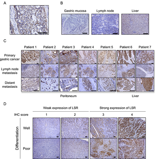 Immunohistochemical (IHC) staining for lipolysis-stimulated lipoprotein receptor (LSR) in gastric cancer (GC) patient samples.