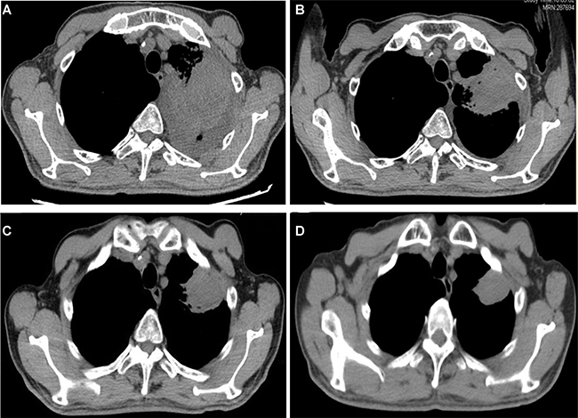 Chest CT showed tumor regression in the left lung after apatinib therapy.
