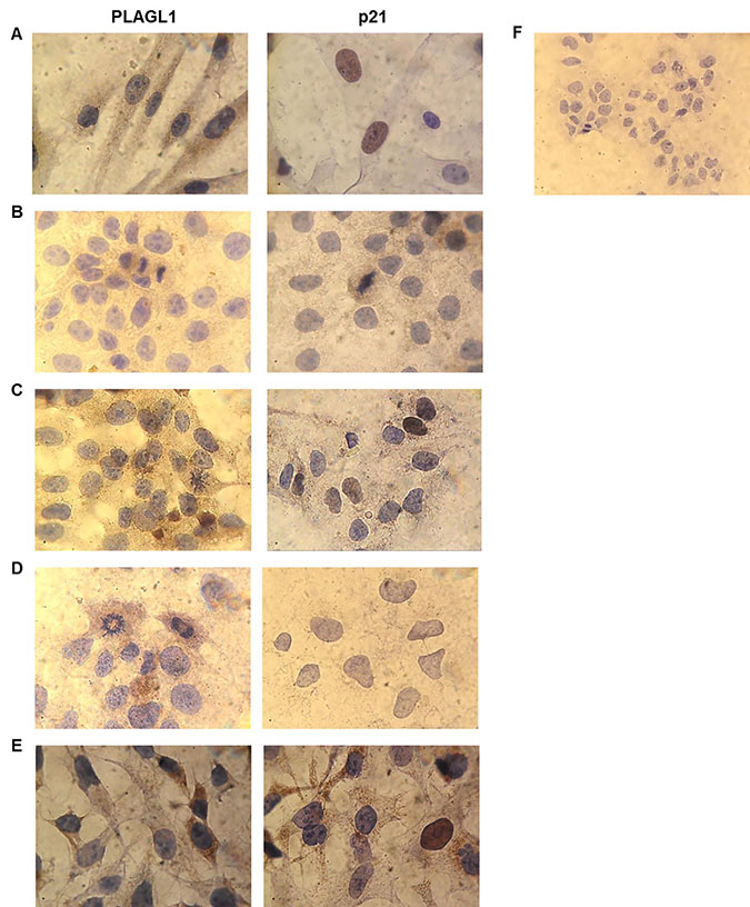 Immunocytochemistry for PLAGL1 and p21 proteins in tumor and normal cells.