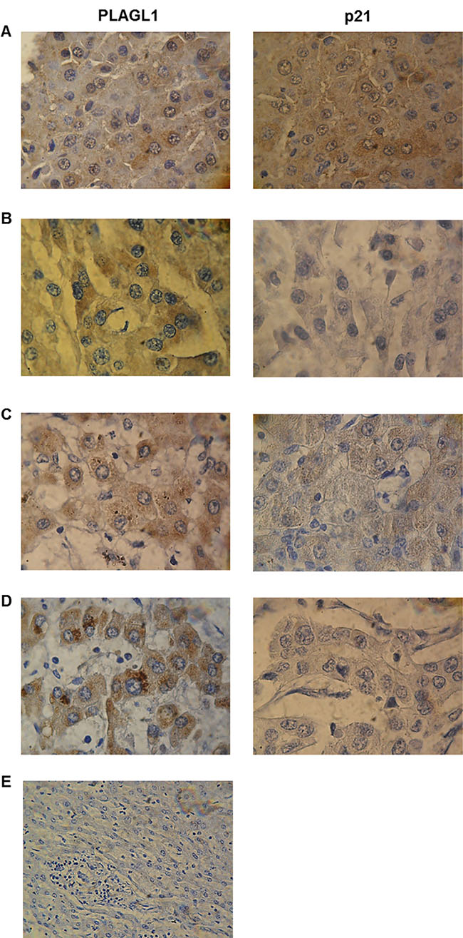 Immunohistochemical analyses of PLAGL1 and p21 proteins expression in liver tumors.