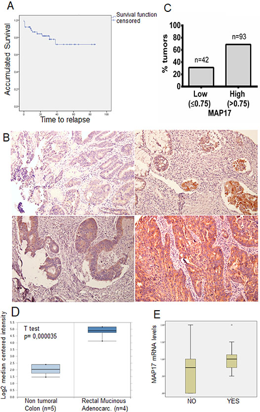 MAP17 upregulation in rectal tumors after concurrent chemoradiotherapy.