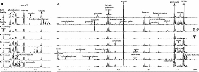 Typical 600 MHz 1H NMR spectra of aqueous faecal extracts from 4 CRC patients and age and sex matched controls.
