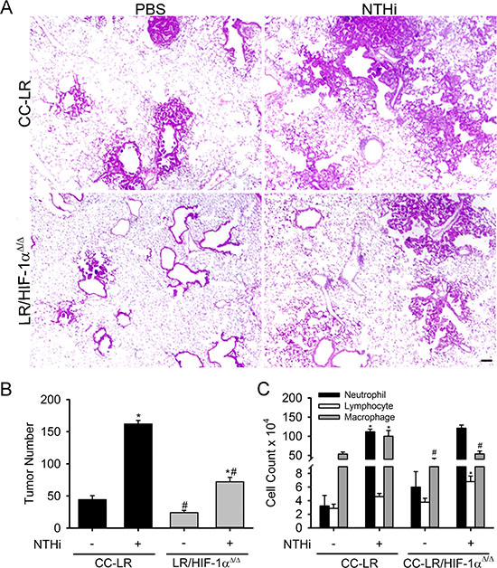 Lack of HIF-1&#x03B1; in the airway epithelium suppresses K-ras induced lung tumorigenesis and its promotion by inflammation.