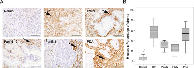 Gal-1 immunohistological expression in normal and pathological human pancreatic tissue samples.